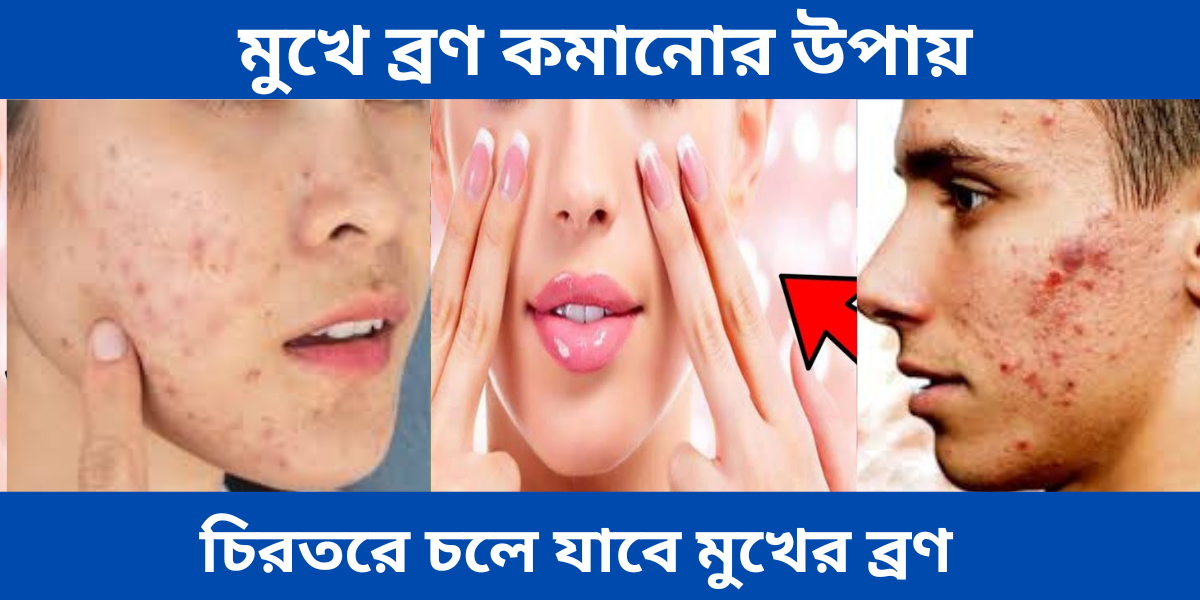 মুখে ব্রণ কমানোর উপায়