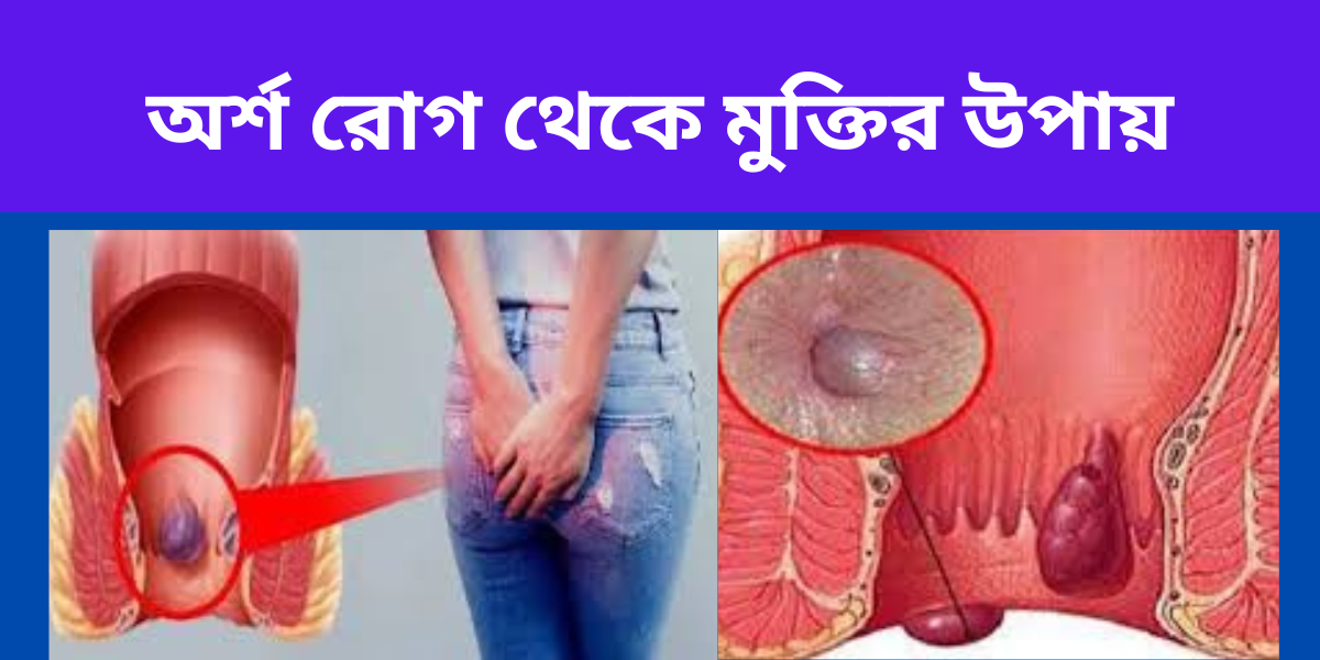 অর্শ রোগ থেকে মুক্তির উপায়