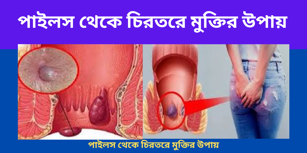 পাইলস থেকে চিরতরে মুক্তির উপায়